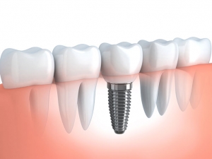 Na czym polegają zabiegi wszczepienia implantów zębowych?
