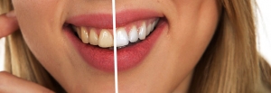 Twoim zębom daleko do doskonałości? Dowiedz się, jak szybko możesz poprawić ich wygląd